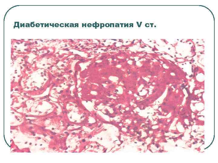 Диабетическая нефропатия V ст. 