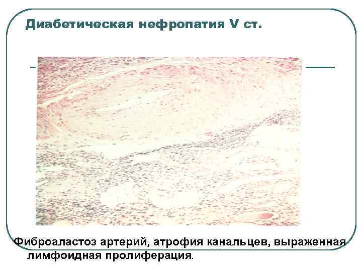  Диабетическая нефропатия V ст. Фиброаластоз артерий, атрофия канальцев, выраженная  лимфоидная пролиферация. 