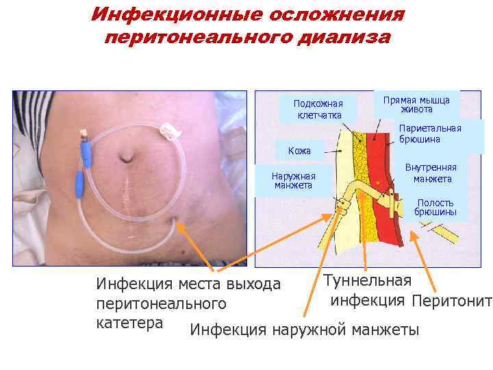 Инфекционные осложнения перитонеального диализа Подкожная Прямая мышца живота клетчатка Париетальная брюшина Кожа Внутренняя Наружная