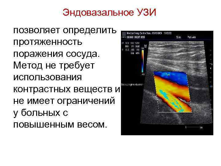    Эндовазальное УЗИ позволяет определить протяженность поражения сосуда.  Метод не требует