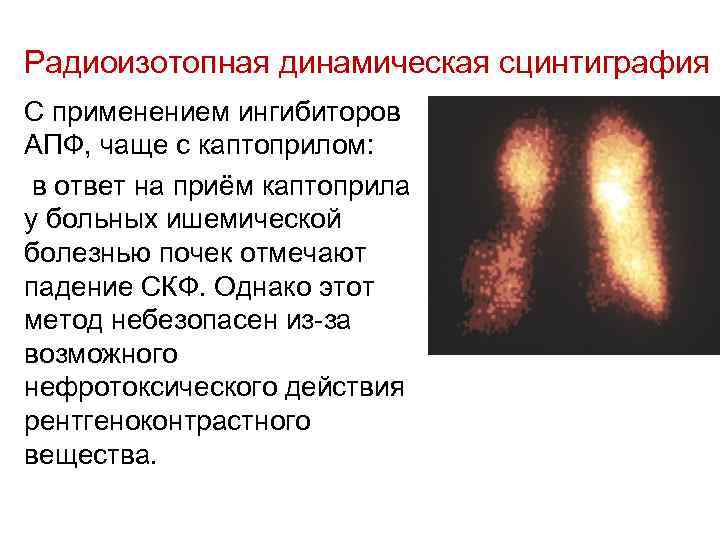 Радиоизотопная динамическая сцинтиграфия С применением ингибиторов АПФ, чаще с каптоприлом:  в ответ на
