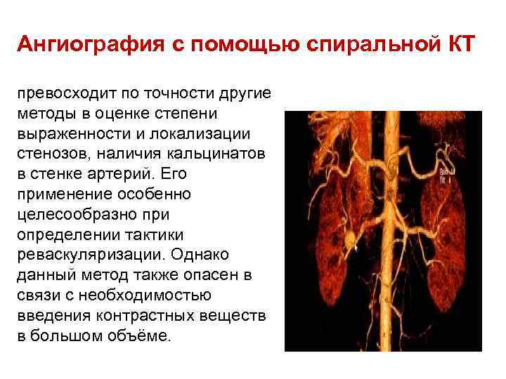 Ангиография с помощью спиральной КТ превосходит по точности другие методы в оценке степени выраженности