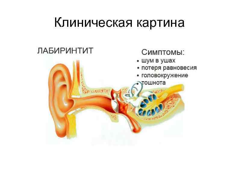 Острый лабиринтит презентация