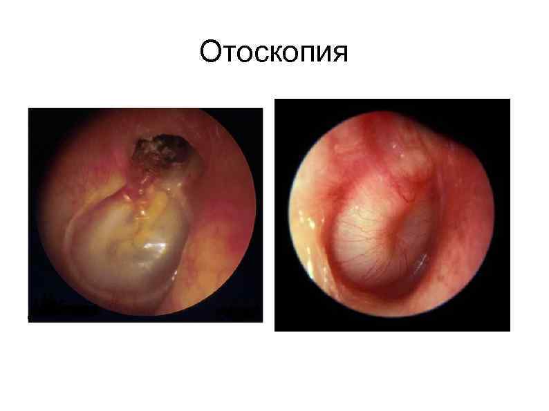 Отоскопия 