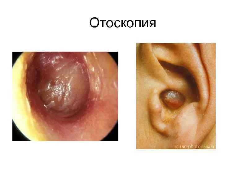 Отоскопия 