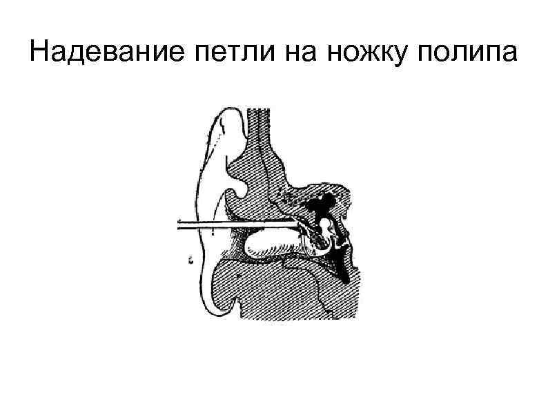 Надевание петли на ножку полипа 