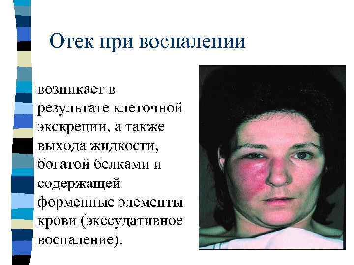  Отек при воспалении – Отечность тканей может образоваться  также и лишь за