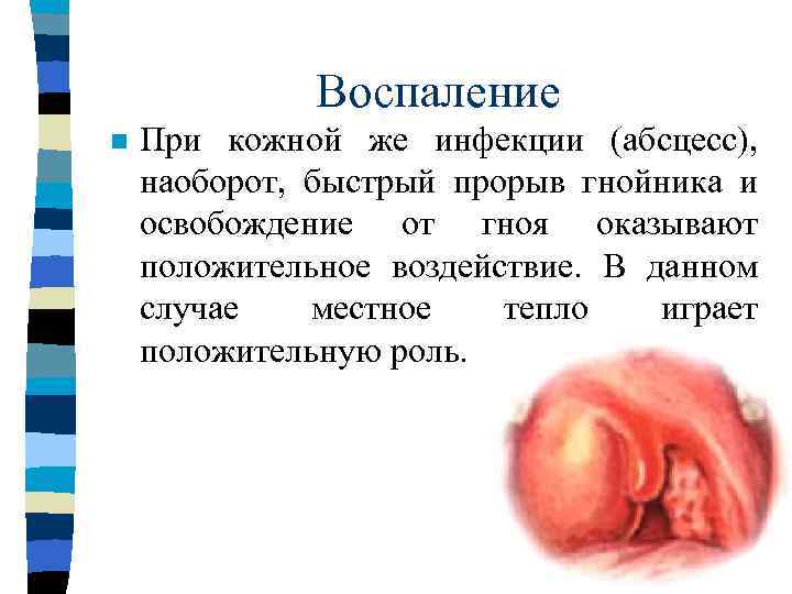    Воспаление n  “Не созревший” и не освободившийся от гноя абсцесс