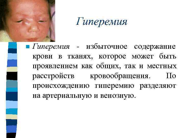    Стаз n  Стаз - остановка кровотока в отдельных капиллярах, мелких