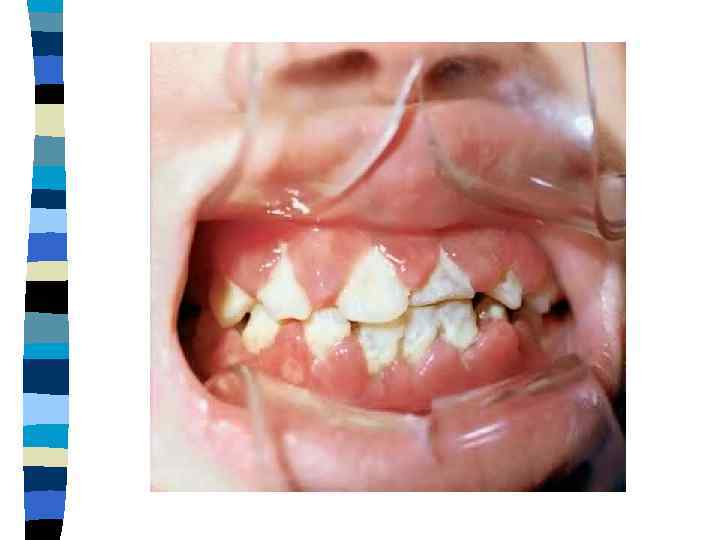     Ишемия n  Ишемия - патологический процесс, при котором в