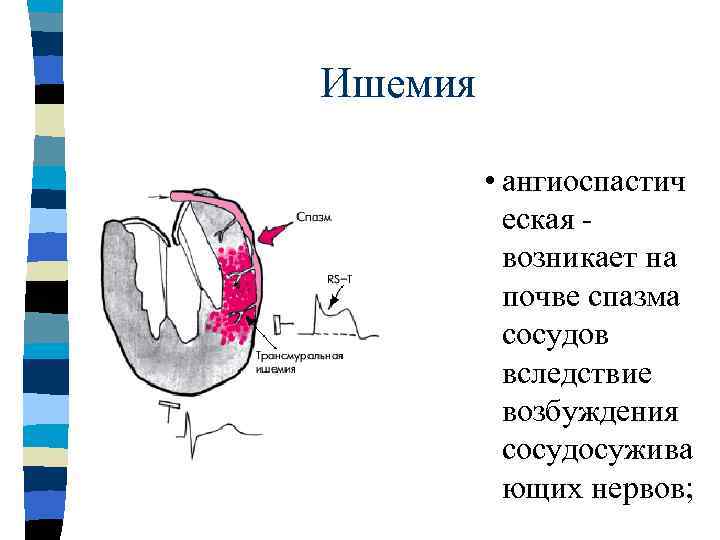     Ишемия n  ·   компрессионна я - развивается