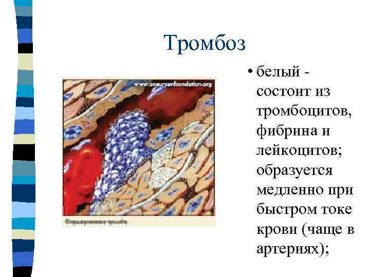 Тромбоз  n смешанный —  встречается наиболее  часто; имеет  слоистое строение