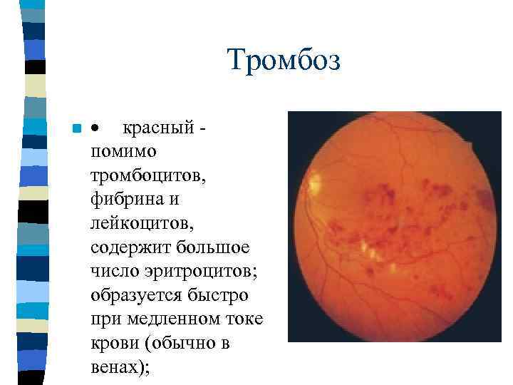    Эмболия n  Эмболия - циркуляция в крови каких- либо