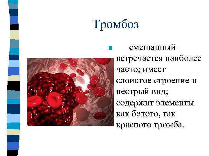     Эмболия n  виды эмболии: n  - по току