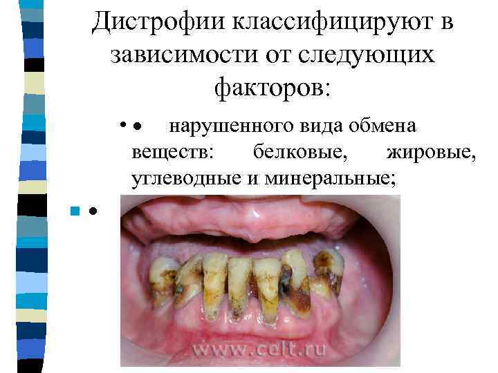   Дистрофии классифицируют в зависимости от следующих   факторов: n  влияния