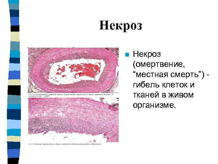 Некроз n  химические  (кислоты, щелочи,   соли, тяжелые  металлы); 