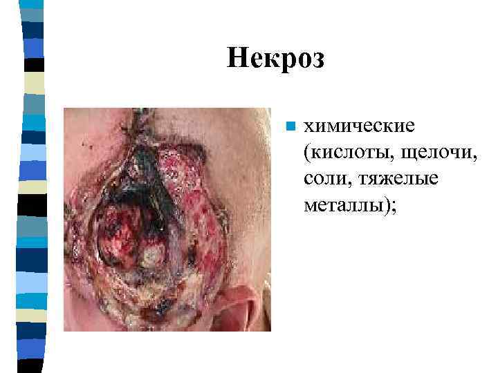     Некроз n физические (высокие и низкие температуры, электричество, лучи Рентгена