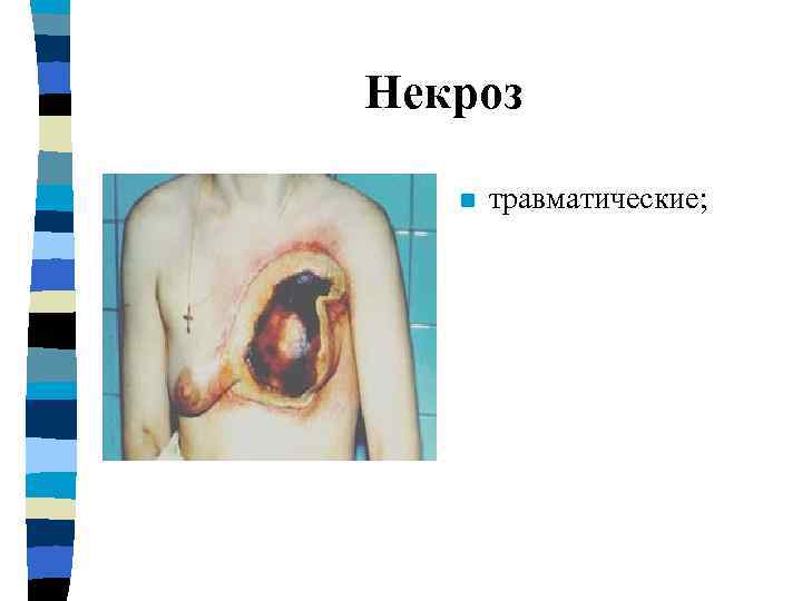 прекращение притока крови; 