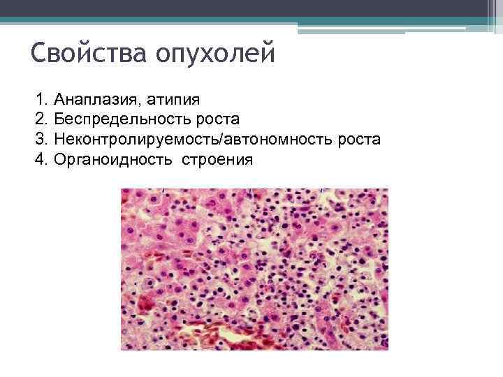 Свойства опухолей 1. Анаплазия, атипия 2. Беспредельность роста 3. Неконтролируемость/автономность роста 4. Органоидность строения