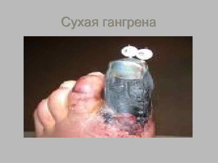    Сухая гангрена §  Состояние пациента удовлетворительное. §  К моменту