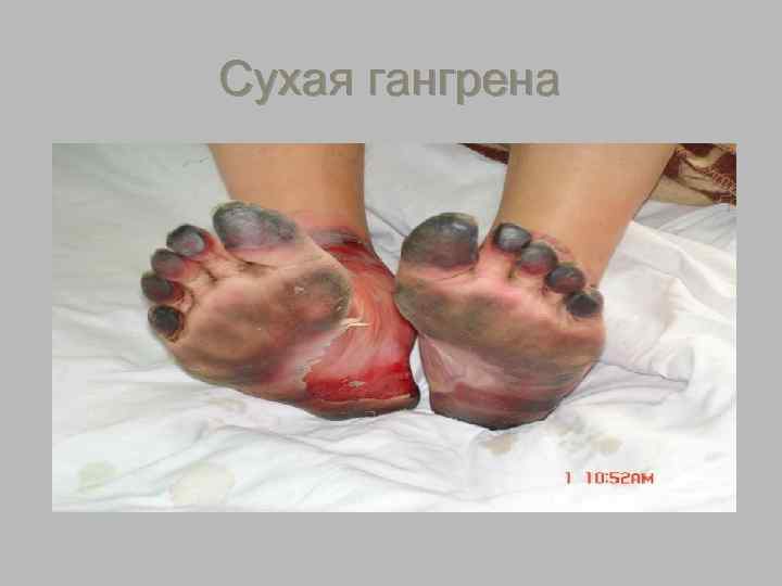 Сухая гангрена 
