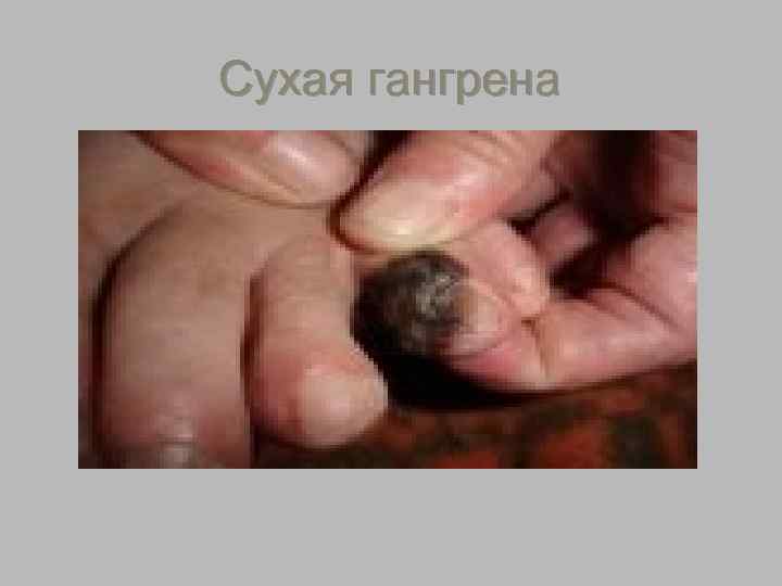 Сухая гангрена 