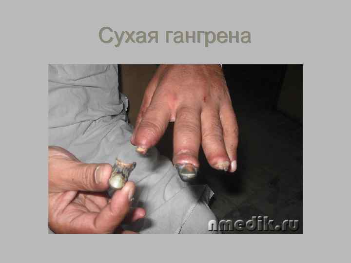 Гангрена культи 