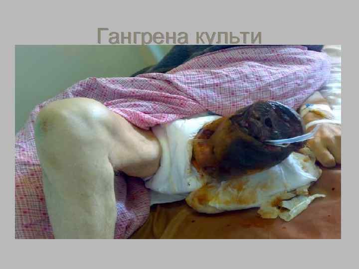   Влажная гангрена § Влажная гангрена характеризуется  серовато-бурым, синюшно-бардовым  цветом пораженной