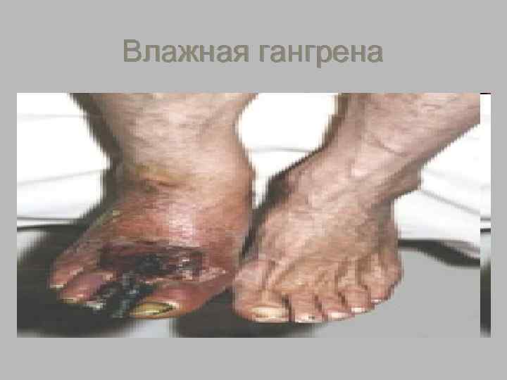 Влажная гангрена 