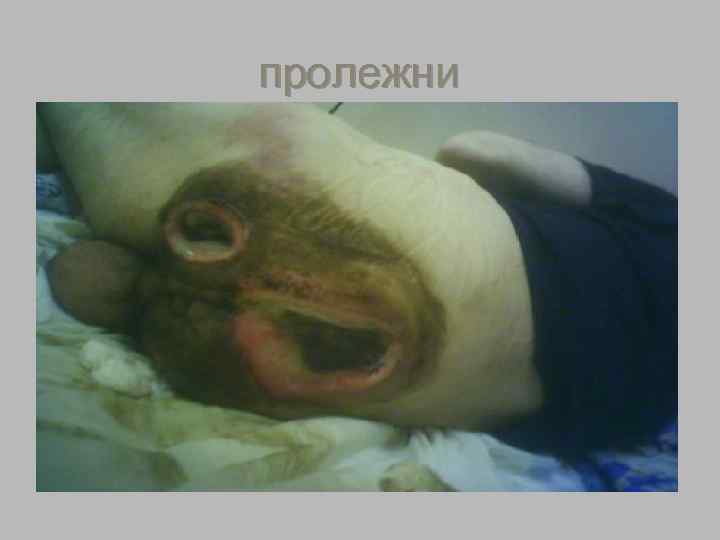   Пролежень результат сдавления тканей 