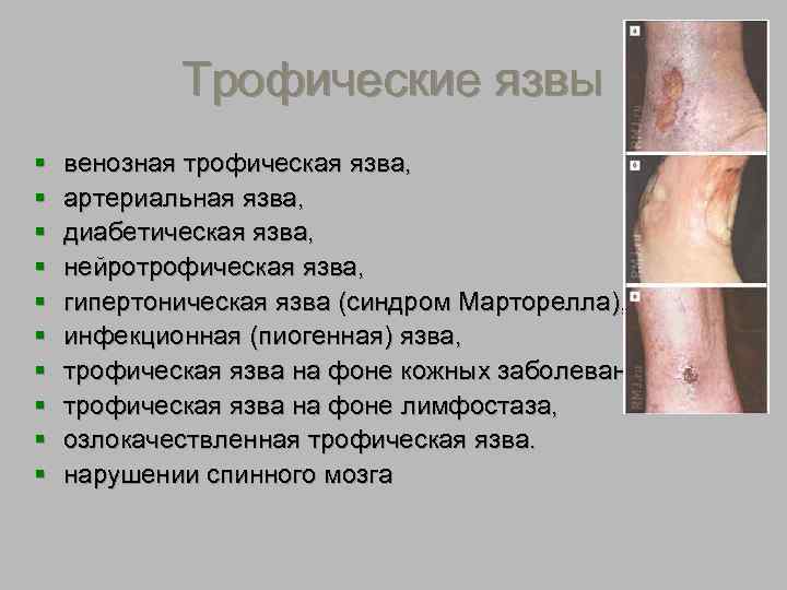 Трофическая язва 