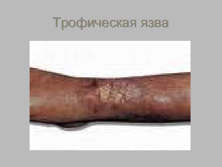 Трофическая язва 