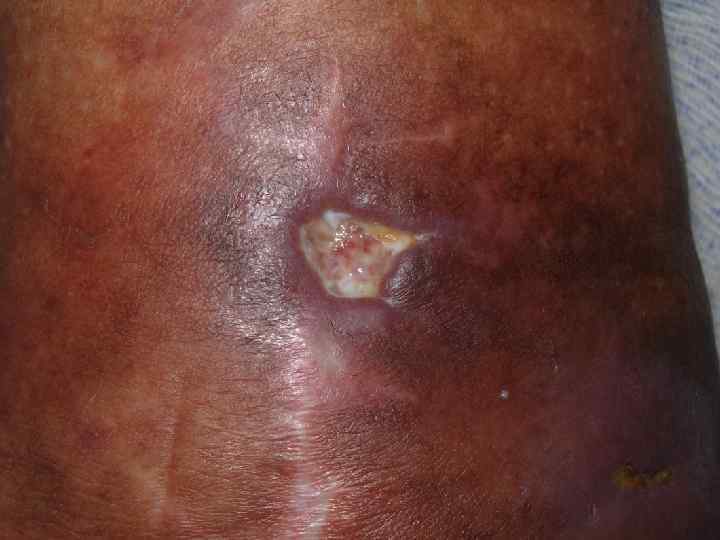 Трофическая язва 