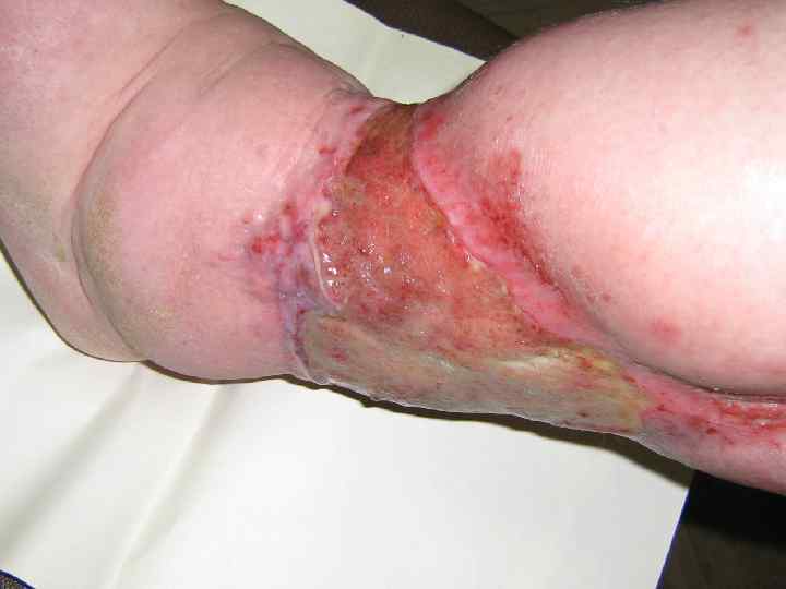   Общие проявления § боли усиливаются после долгой ходьбы  или физических нагрузок,