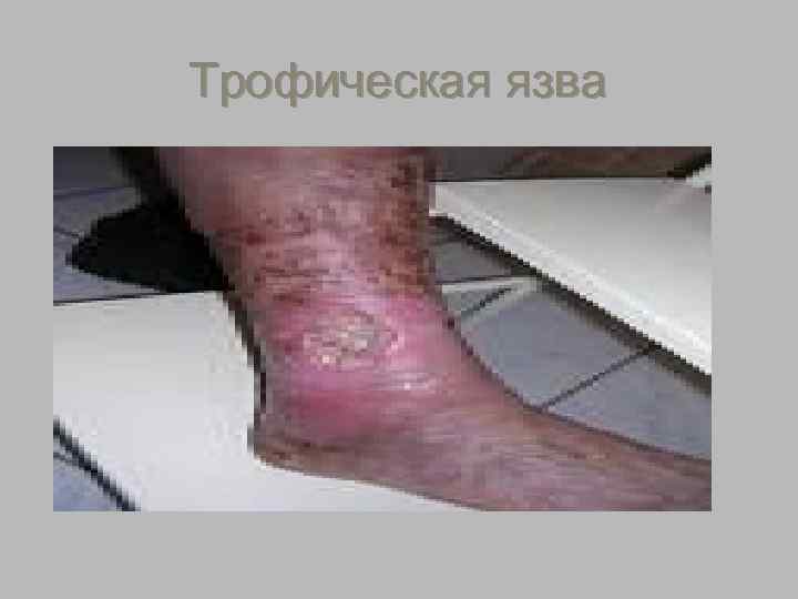  Лечение трофических язв § 1. Соблюдение режима труда и отдыха с ограничением 