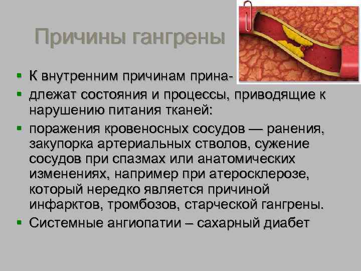  Причины гангрены § К внутренним причинам прина- § длежат состояния и процессы, приводящие