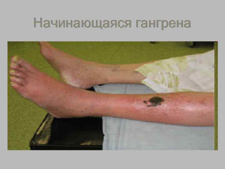 Начинающаяся гангрена 
