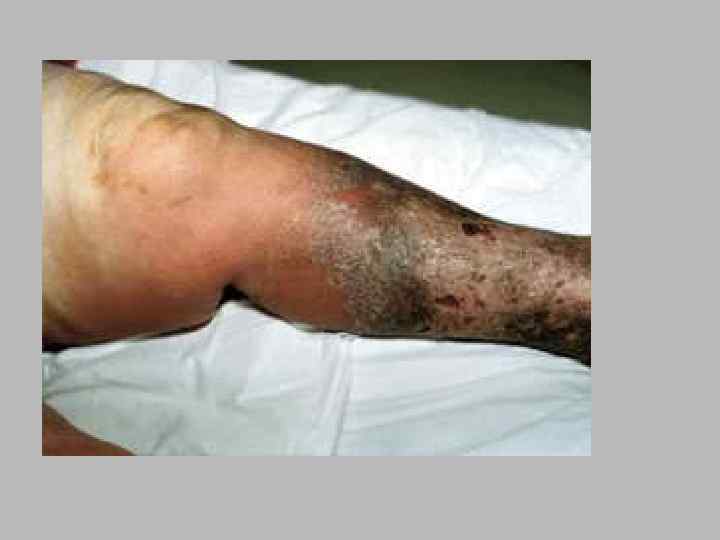    Сухая гангрена § Происходит высыхание, сморщивание и  уплотнение тканей. Пораженная