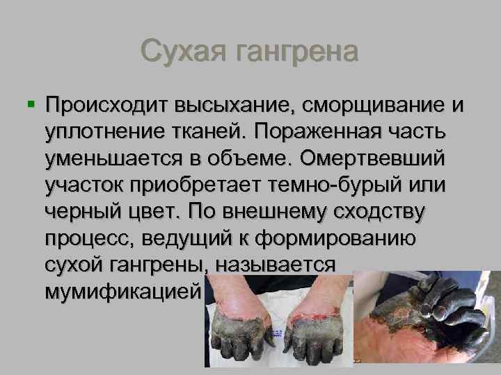 Сухая гангрена 