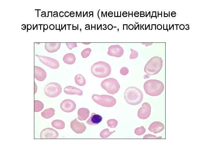 Акантоцитоз 
