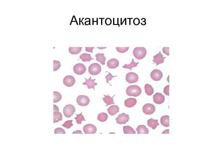 Наследственный  стоматоцитоз 