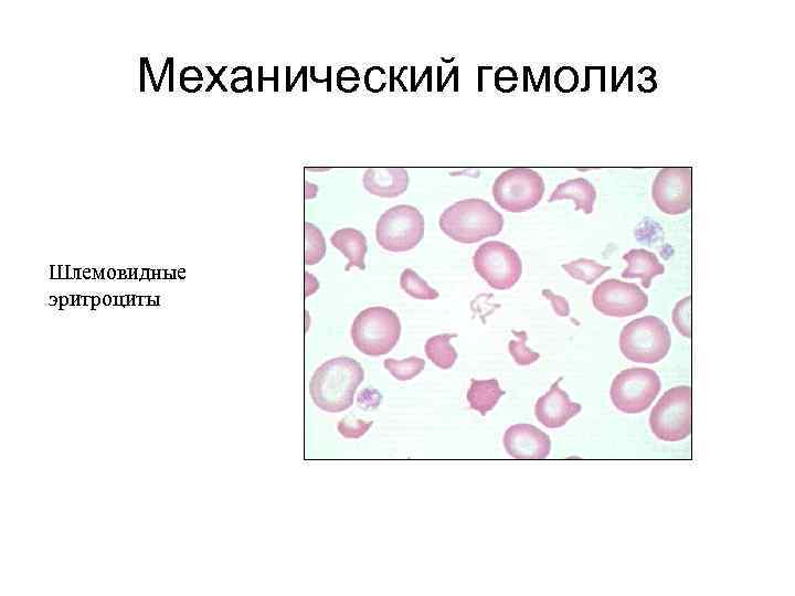 Макроцитоз, пойкилоцитоз,  анизоцитоз, гиперхромия 
