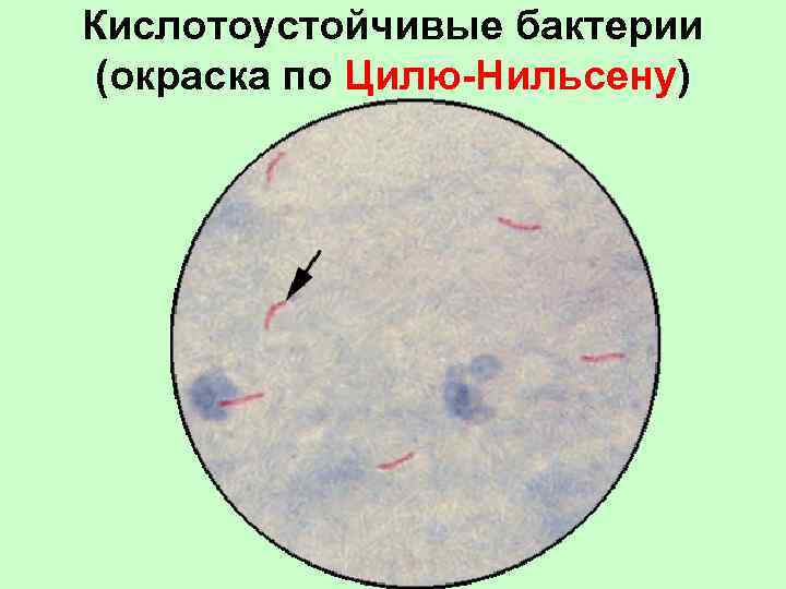 Кислотоустойчивые бактерии (окраска по Цилю-Нильсену) 