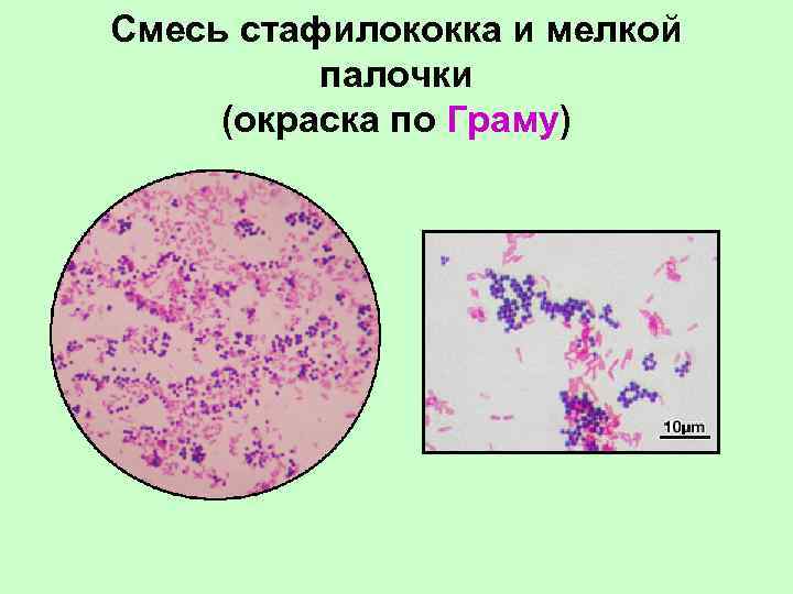 Смесь стафилококка и мелкой палочки (окраска по Граму) 