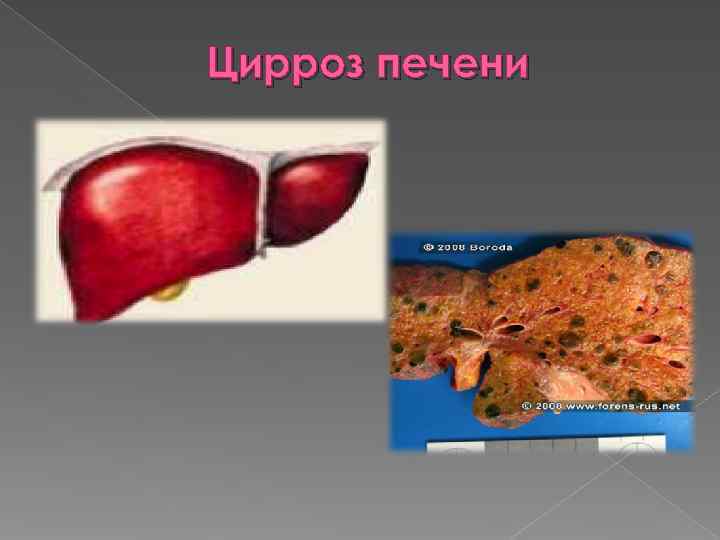 Цирроз печени 