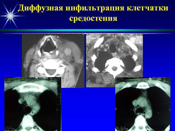 Диффузная инфильтрация клетчатки  средостения 