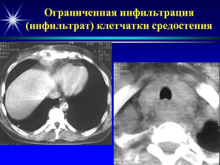  Ограниченная инфильтрация (инфильтрат) клетчатки средостения 