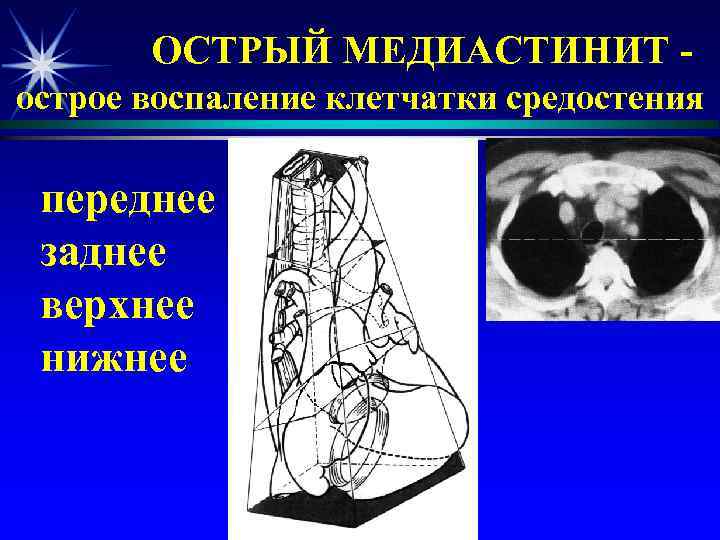   ОСТРЫЙ МЕДИАСТИНИТ - острое воспаление клетчатки средостения  переднее заднее верхнее нижнее