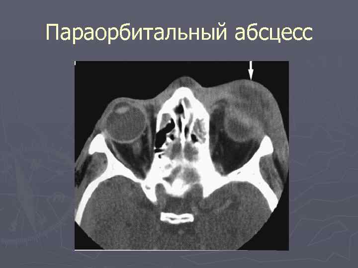 Параорбитальный абсцесс 