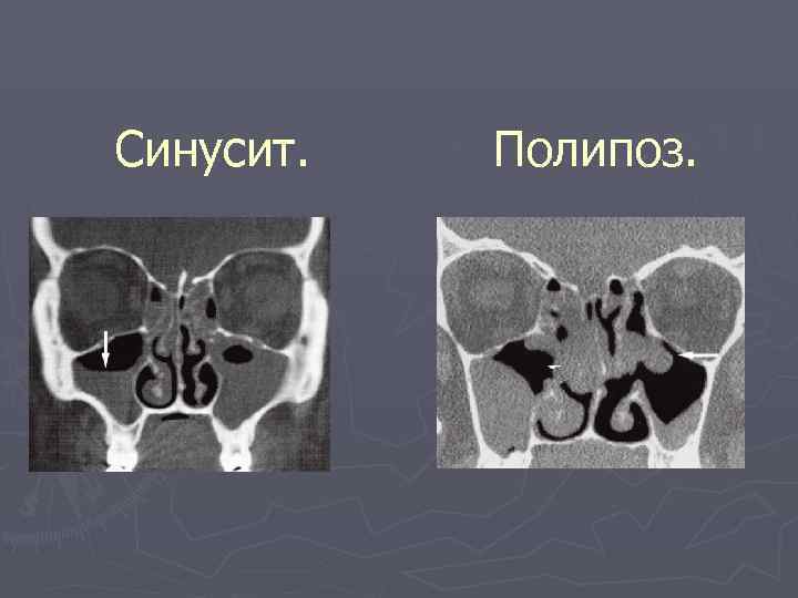 Синусит. Полипоз. 